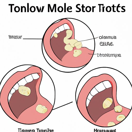 How to Make Tonsil Stones Fall Out Natural Remedies and Prevention