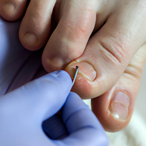 How to Treat Ingrown Toenail A StepbyStep Guide for Relief The
