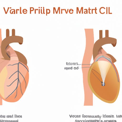 Mitral Valve Prolapse Understanding, Living, and Thriving The Riddle